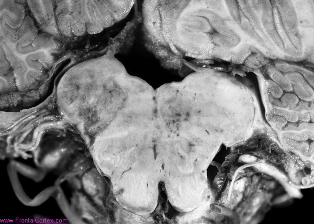 Recent infarct, dorsal medulla